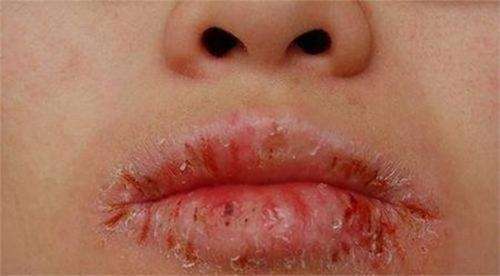 过敏性唇炎,指具有过敏体质的人在受到气候,光照,接触口红,刺激性物质